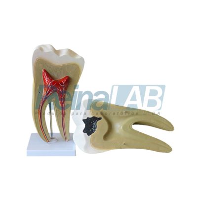 dente-molar-ampliado-saudável-e-com-cárie-1