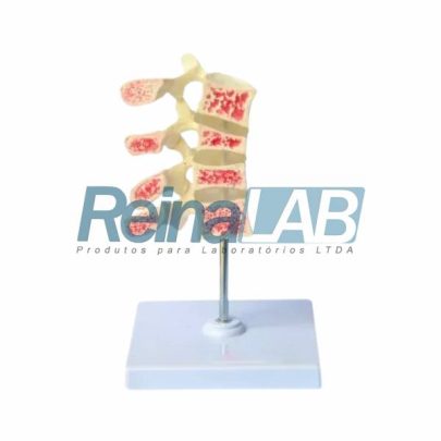Modelo de Osteoporose 4 Vértebras