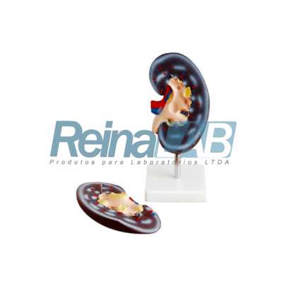 Modelo de Rim Desmontável em 2 Partes